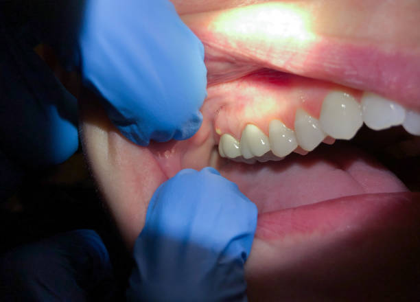 Best Teeth Whitening  in Palouse, WA